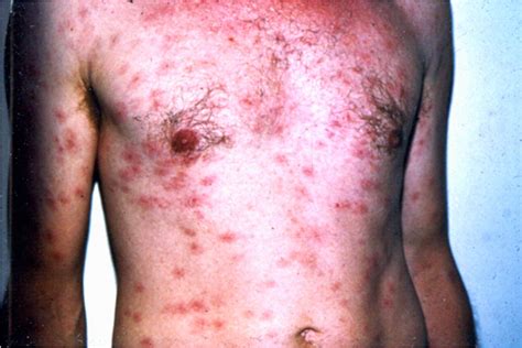 SyphilisInterActive Health