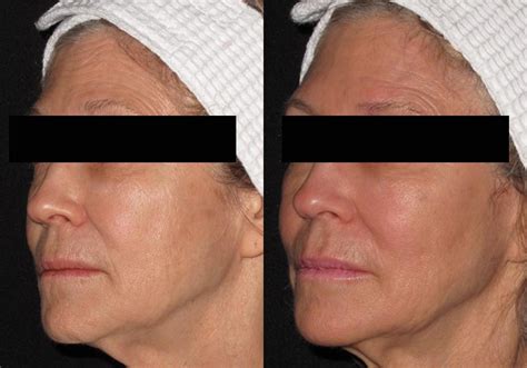 Dermal Fillers Case 73 Before and After Photos Milwaukee