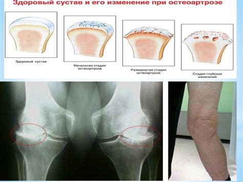 Реактивті артрит - презентация онлайн