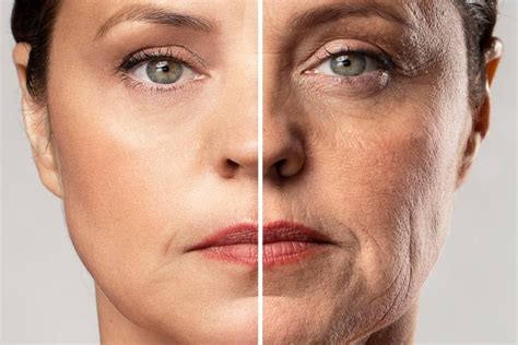 Aptos Threads for face tightening - Lift sagging tissue, restore lost