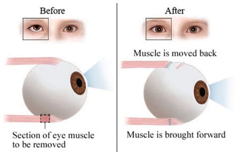 Squint Eye Treatment for Adults | Causes, Methods and Risks | Eyemantra