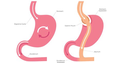 The Patient's Perspective: A Journey with Gastric Bypass Surgery