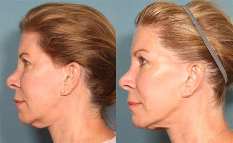 Skin Tightening & Wrinkle Removal Treatment in Clearwater FL