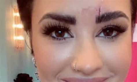 Demi Lovato needs stitches after ‘hitting head on a crystal’ – myTalk 107.1