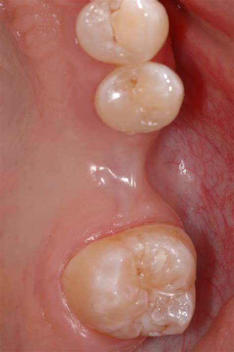 New Crowns For The Maxillary Second Molar Will Last Longer