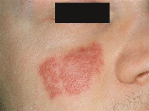 Borrelial Lymphocytoma On Cheek