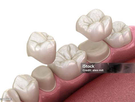 porcelain crowns placement  premolar  molar teeth medically