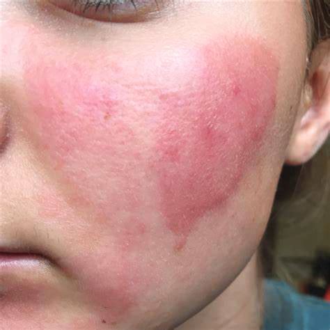 burn marks lucie  medical spa