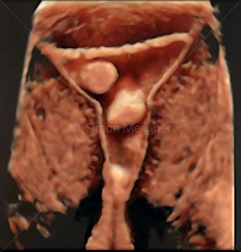 3D Render Post Saline Infusion Sonography-Two intrauterine polyps- (2) — Melbourne International ...