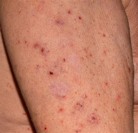 The Unseen Enemy: Escaping The Cycle Of Scabies