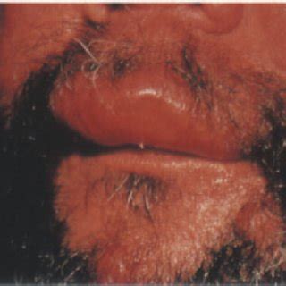 11. Borderline leprosy: erythema and infiltration of the lip | Download ...