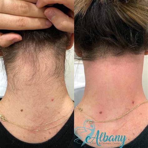 Laser Hair Removal: Case No. 1376 Albany Cosmetic and Laser Centre