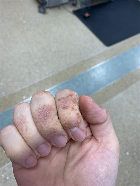 Irritant contact dermatitis to nitrile gloves? : r/Dermatology