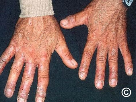 Hand eczema, hand dermatitis
