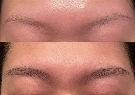 does minoxidil actually work 9