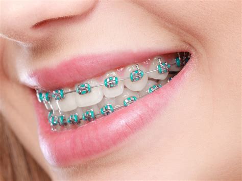 braces survival kit plano willow bend orthodontics