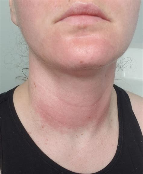 Why Does Heat Irritate My Skin at Beverly Marone blog