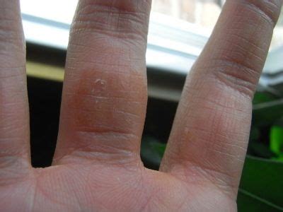 Мозоли на пальцах рук: причины появления, фото и виды - как избавиться ...