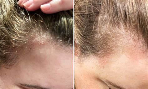 psoriasis   friends  scalp psoriasis