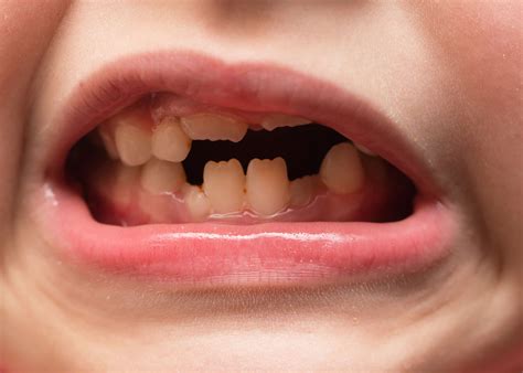 What are Teeth Made Out Of? - Pediatric Dentistry of Central Florida