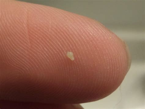 Sebum Plug