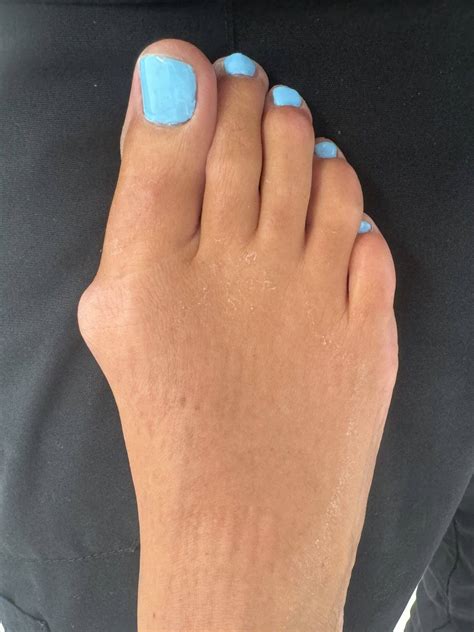 Minimally Invasive Bunion Surgery | Northwest Surgery Center