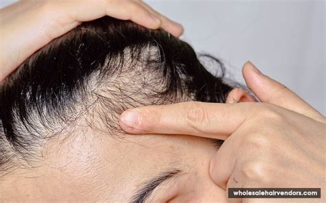 Is The Head And Shoulders Bad For Your Hair? - Ivirgo