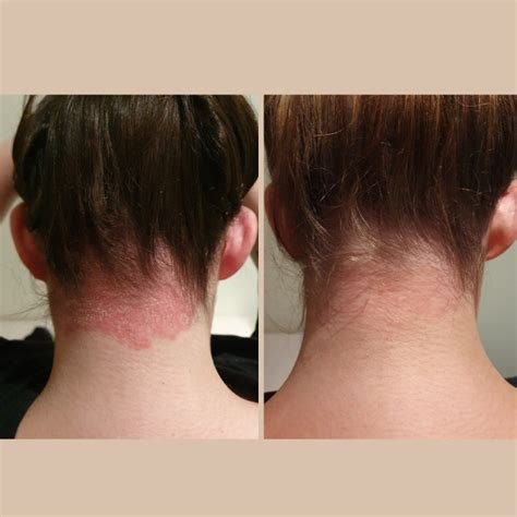 Signs of Scalp Psoriasis: How to Support Your Suffering Clients From ...