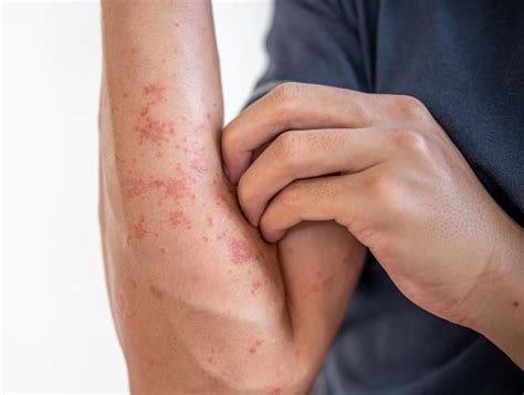 What is the link between eczema, asthma and food allergies? - CNA Lifestyle