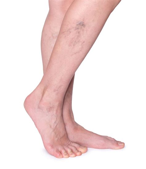 Laser Ablation for Varicose Veins in NY, NJ and CT