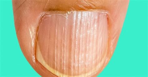 Unhas Com Estrias Verticais - RETOEDU