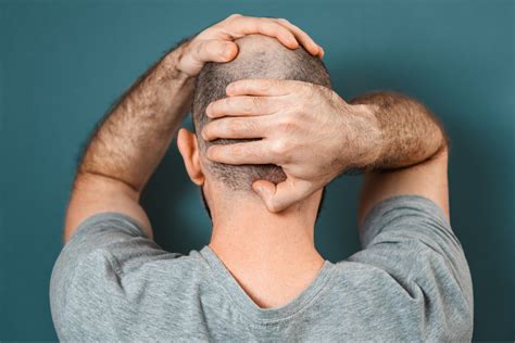 Alopecia Areata: Causes, Symptoms, and Treatment Options : Top Hair ...