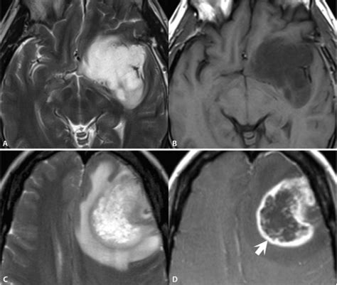Supratentorial Brain Neoplasms | Radiology Key