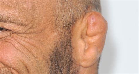 Cauliflower Ear Before And After