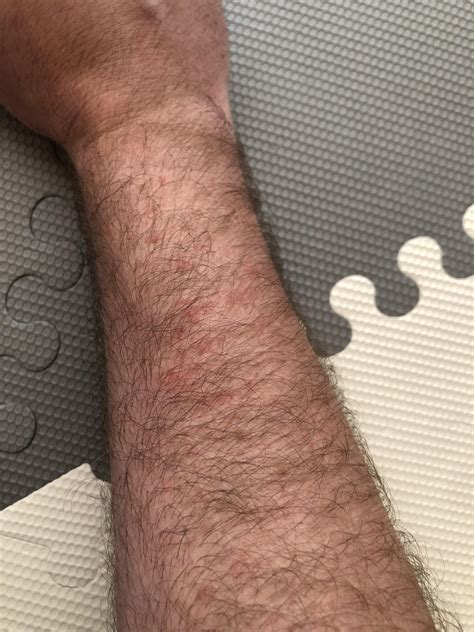 Painful and itchy Rash spreading up both forearms. Male, 32, otherwise