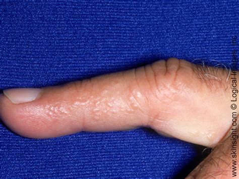 Dyshidrotic Eczema: Symptoms, Causes, Treatment | National Eczema ...