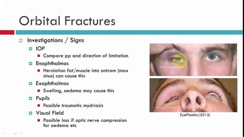 pics orbital floor fracture surgery complications  view alqu blog