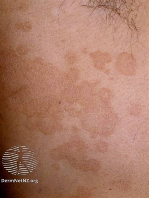 Tinea Versicolor Before And After