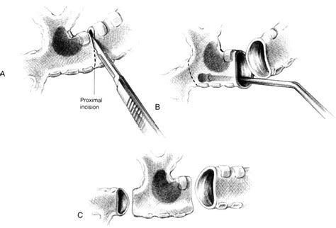 left upper lobe sleeve resection operative techniques  thoracic