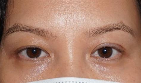 Asymmetrical Eyelid Creases & How Blepharoplasty Can Help
