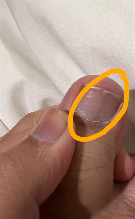 Longtudinal pale brown line on toes. should i be concerned? : r