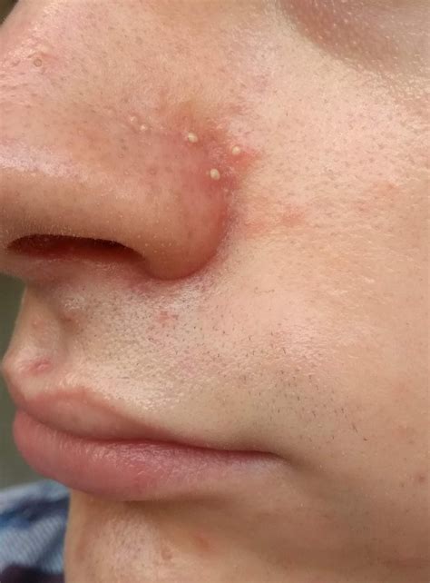 [Acne] Itchy, sore and red around nose with pustules. What's going on