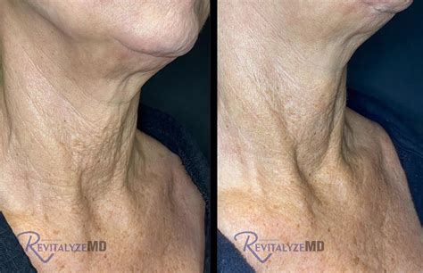 Biostimulatory Fillers Knoxville | RevitalyzeMD