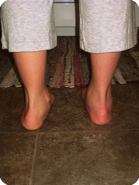 My Blog to Inform anyone wanting the Calcaneal Osteotomy surgery