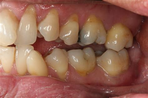 dental cervical erosion   attrition erosion abrasion