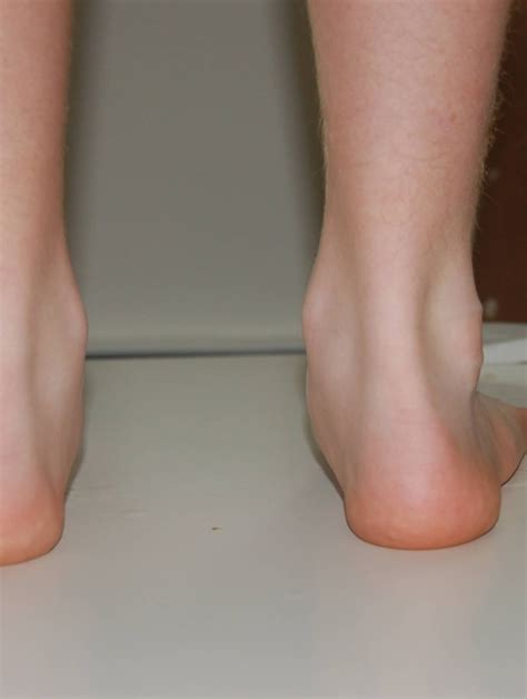 Tibialis Anterior Foot Pain