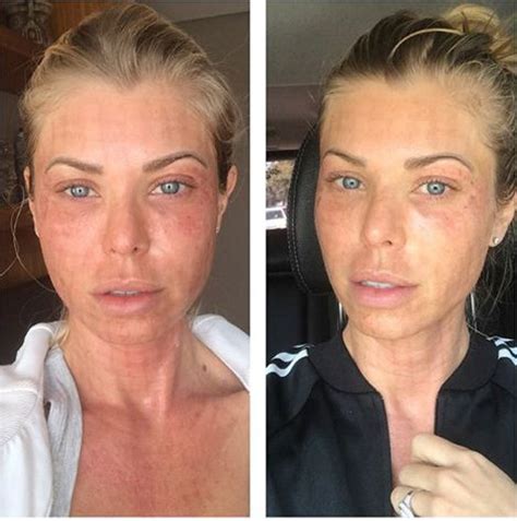 Laser Fotona No Rosto Antes E Depois - Laser Fotona No Rosto Antes E Depois - Cultura Notícias