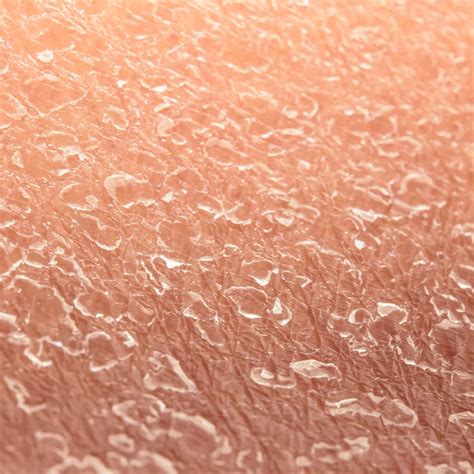 Conditions - Victor Dermatology