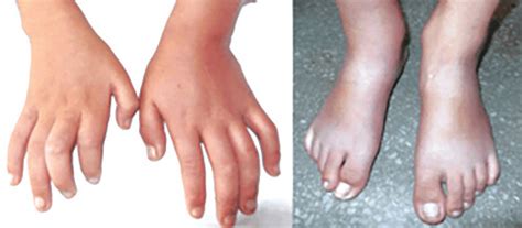 Figure 1: Photograph showing comparative shorting of the right hand and ...