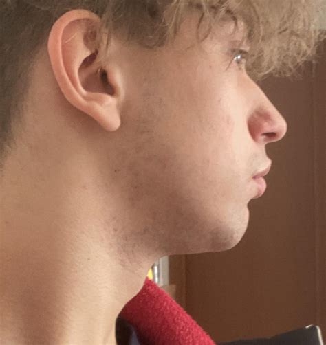 fix   bad jaw   losing weight